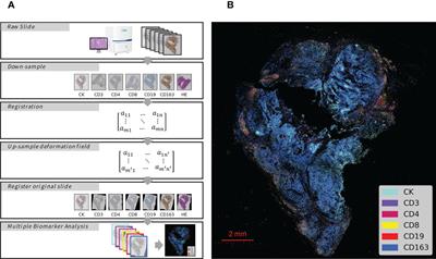 Prognostic value of various immune cells and Immunoscore in triple-negative breast cancer